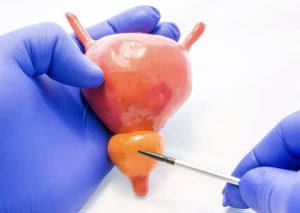 Biopsie de la prostate : comment se déroule l’examen ?